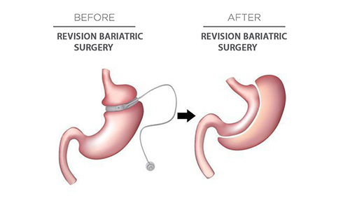 Revision weight loss surgery